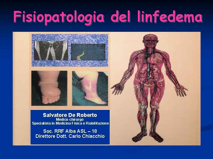 Fisiopatologia del linfedema Salvatore De Roberto Medico chirurgo Specialista in Medicina Fisica e Riabilitazione