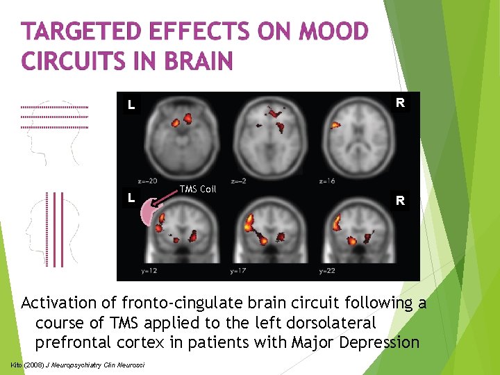 R L L TMS Coil R Activation of fronto-cingulate brain circuit following a course