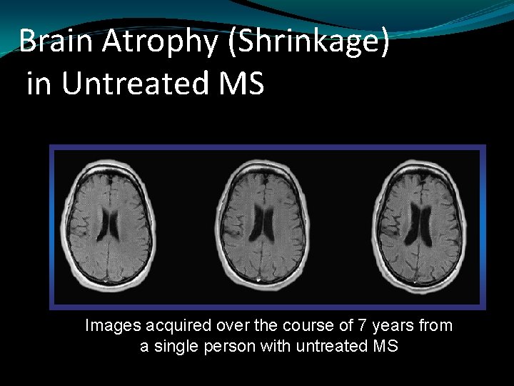 Brain Atrophy (Shrinkage) in Untreated MS Images acquired over the course of 7 years