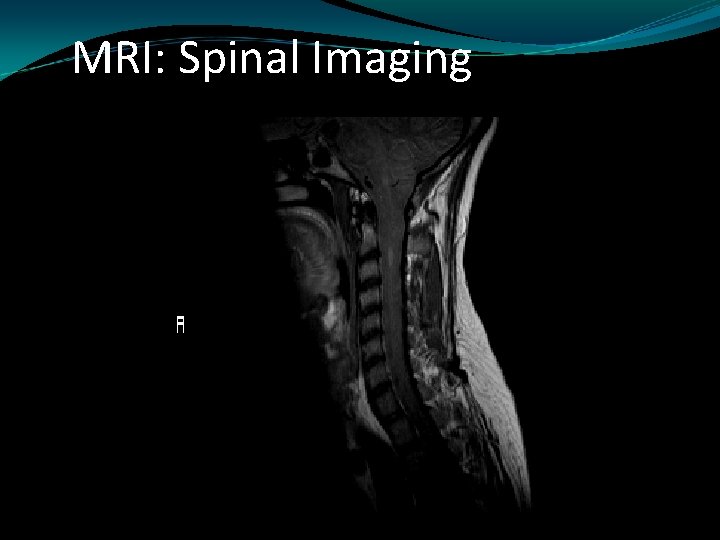 MRI: Spinal Imaging 