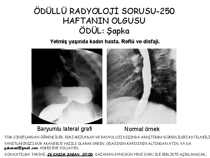 ÖDÜLLÜ RADYOLOJİ SORUSU-250 HAFTANIN OLGUSU ÖDÜL: Şapka Yetmiş yaşında kadın hasta. Reflü ve disfaji.