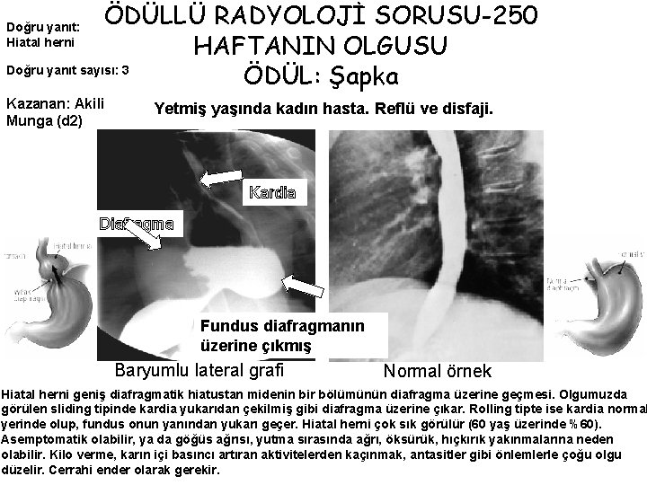 ÖDÜLLÜ RADYOLOJİ SORUSU-250 HAFTANIN OLGUSU Doğru yanıt sayısı: 3 ÖDÜL: Şapka Doğru yanıt: Hiatal