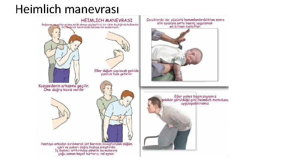 Heimlich manevrası 