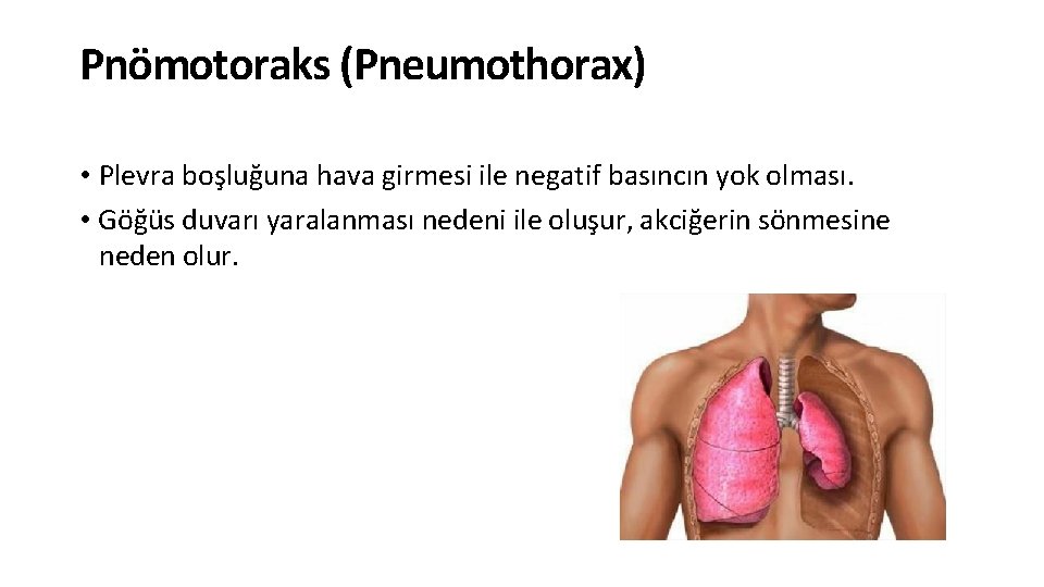 Pnömotoraks (Pneumothorax) • Plevra boşluğuna hava girmesi ile negatif basıncın yok olması. • Göğüs