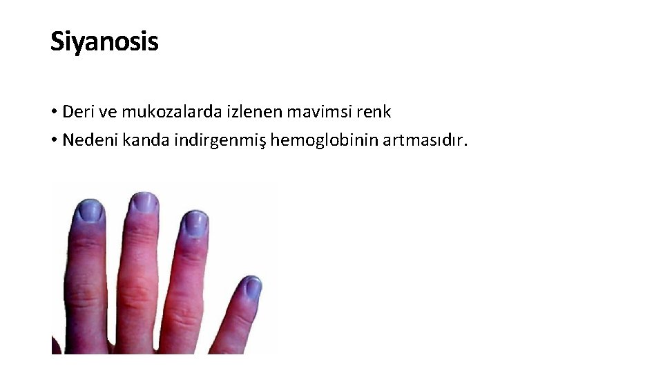 Siyanosis • Deri ve mukozalarda izlenen mavimsi renk • Nedeni kanda indirgenmiş hemoglobinin artmasıdır.