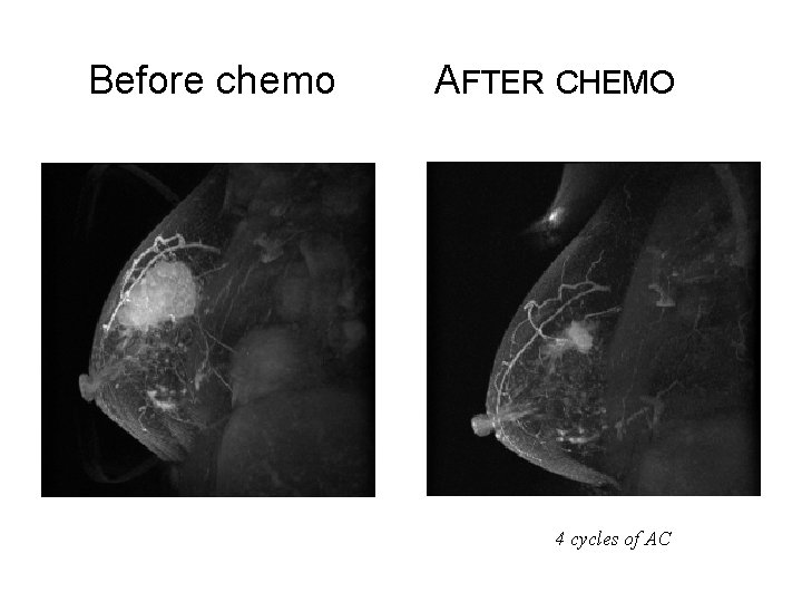 Before chemo AFTER CHEMO 4 cycles of AC 