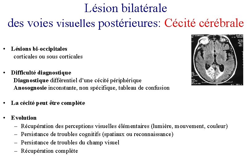 Lésion bilatérale des voies visuelles postérieures: Cécité cérébrale • Lésions bi-occipitales corticales ou sous