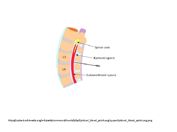 https: //upload. wikimedia. org/wikipedia/commons/thumb/b/ba/Epidural_blood_patch. svg/250 px-Epidural_blood_patch. svg. png 