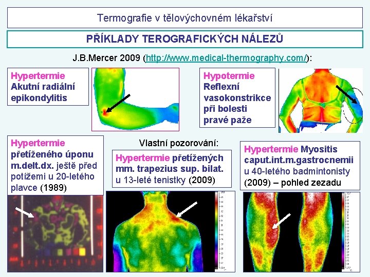 Termografie v tělovýchovném lékařství PŘÍKLADY TEROGRAFICKÝCH NÁLEZŮ J. B. Mercer 2009 (http: //www. medical-thermography.