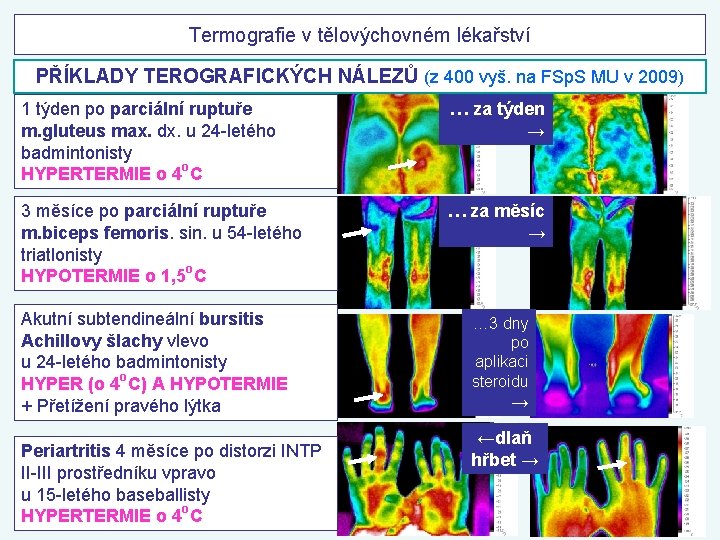 Termografie v tělovýchovném lékařství PŘÍKLADY TEROGRAFICKÝCH NÁLEZŮ (z 400 vyš. na FSp. S MU