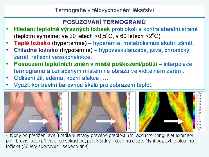 Termografie v tělovýchovném lékařství • • • POSUZOVÁNÍ TERMOGRAMŮ Hledání teplotně výrazných ložisek proti
