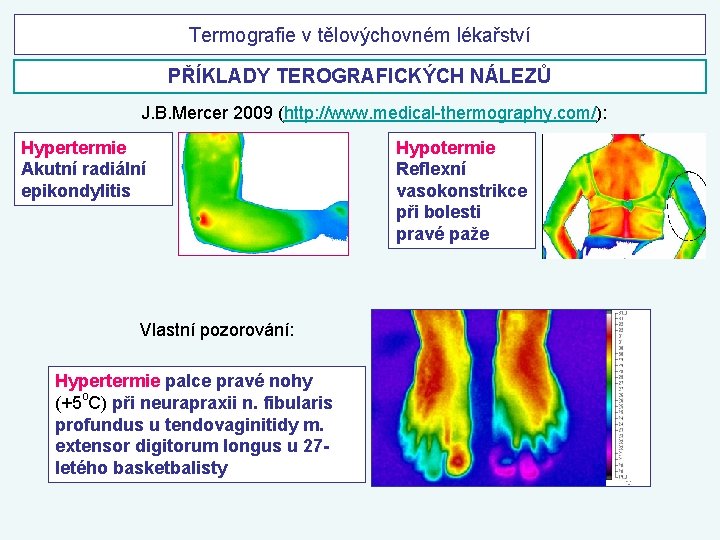 Termografie v tělovýchovném lékařství PŘÍKLADY TEROGRAFICKÝCH NÁLEZŮ J. B. Mercer 2009 (http: //www. medical-thermography.