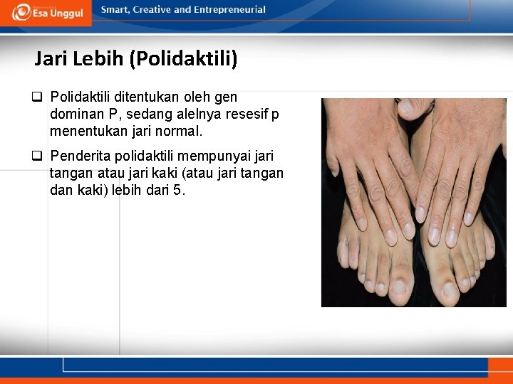 Jari Lebih (Polidaktili) q Polidaktili ditentukan oleh gen dominan P, sedang alelnya resesif p