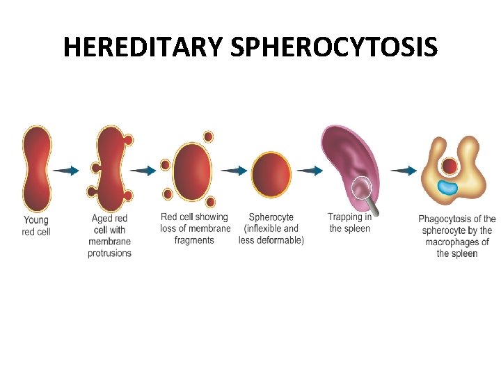 HEREDITARY SPHEROCYTOSIS 