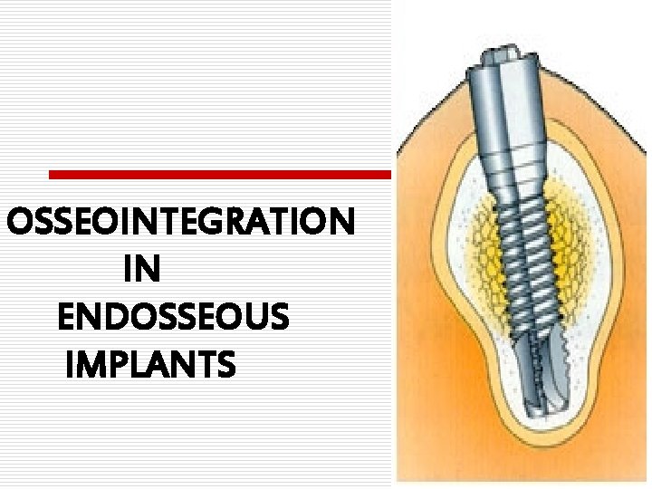 OSSEOINTEGRATION IN ENDOSSEOUS IMPLANTS 