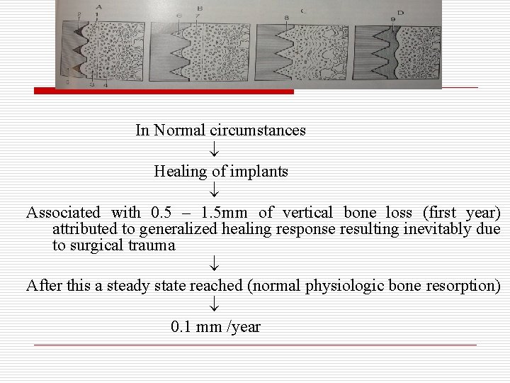 In Normal circumstances Healing of implants Associated with 0. 5 – 1. 5 mm