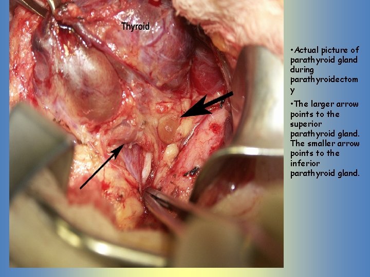 • Actual picture of parathyroid gland during parathyroidectom y • The larger arrow • Actual picture of parathyroid gland during parathyroidectom y • The larger arrow