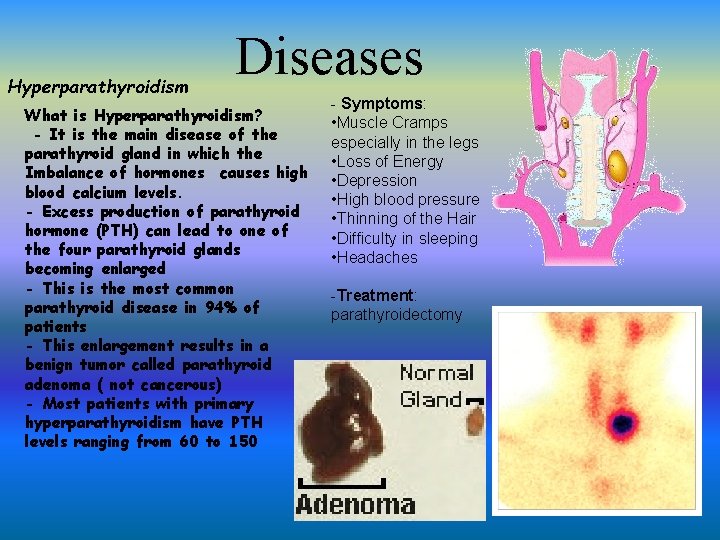 Hyperparathyroidism Diseases What is Hyperparathyroidism? - It is the main disease of the parathyroid Hyperparathyroidism Diseases What is Hyperparathyroidism? - It is the main disease of the parathyroid