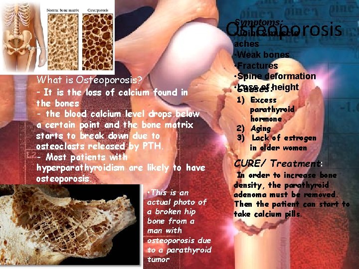 Osteoporosis What is Osteoporosis? - It is the loss of calcium found in the Osteoporosis What is Osteoporosis? - It is the loss of calcium found in the