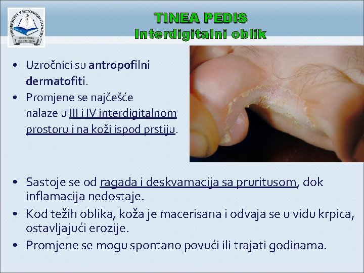TINEA PEDIS Interdigitalni oblik • Uzročnici su antropofilni dermatofiti. • Promjene se najčešće nalaze