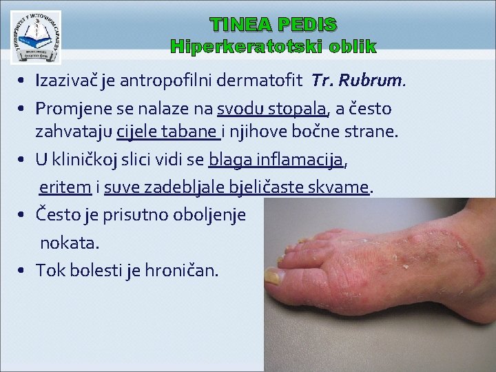 TINEA PEDIS Hiperkeratotski oblik • Izazivač je antropofilni dermatofit Tr. Rubrum. • Promjene se