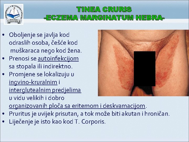 TINEA CRURIS -ECZEMA MARGINATUM HEBRA • Oboljenje se javlja kod odraslih osoba, češće kod