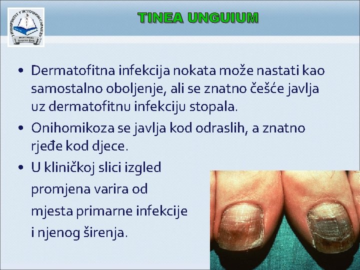 TINEA UNGUIUM • Dermatofitna infekcija nokata može nastati kao samostalno oboljenje, ali se znatno