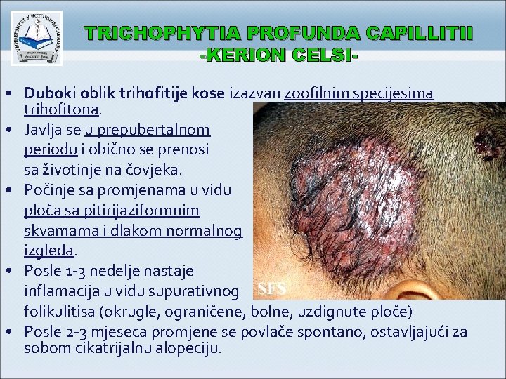 TRICHOPHYTIA PROFUNDA CAPILLITII -KERION CELSI • Duboki oblik trihofitije kose izazvan zoofilnim specijesima trihofitona.