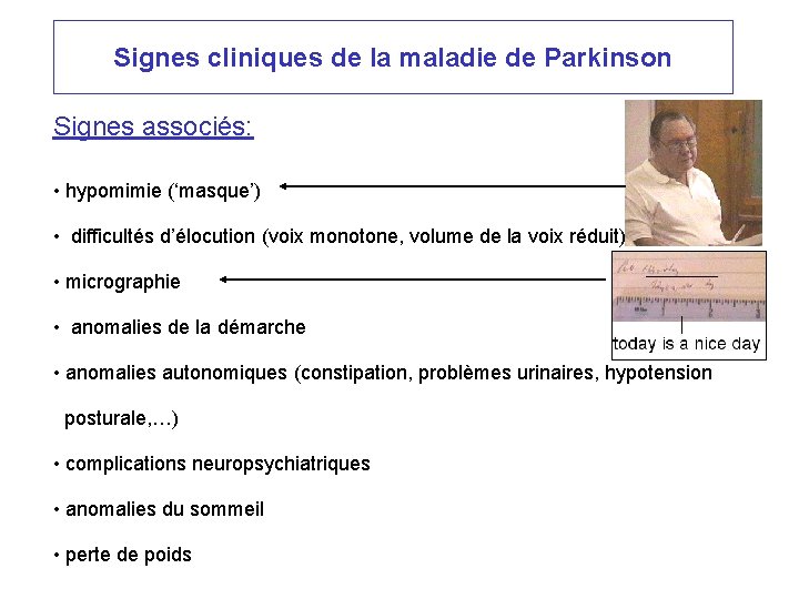 Signes cliniques de la maladie de Parkinson Signes associés: • hypomimie (‘masque’) • difficultés