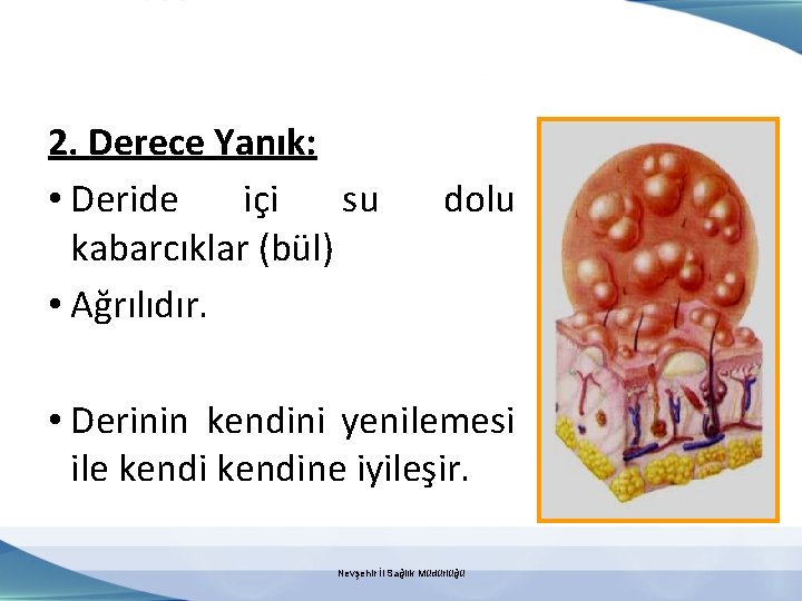 2. Derece Yanık: • Deride içi su kabarcıklar (bül) • Ağrılıdır. dolu • Derinin