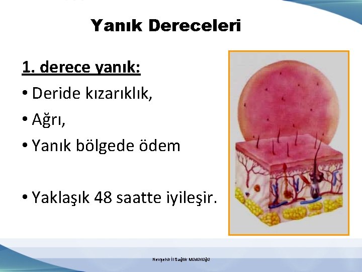 Yanık Dereceleri 1. derece yanık: • Deride kızarıklık, • Ağrı, • Yanık bölgede ödem