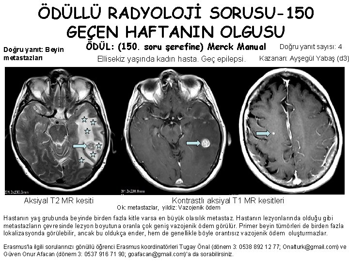 ÖDÜLLÜ RADYOLOJİ SORUSU-150 GEÇEN HAFTANIN OLGUSU Doğru yanıt: Beyin metastazları ÖDÜL: (150. soru şerefine)