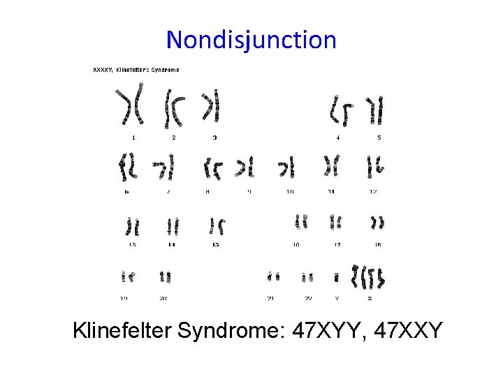 Nondisjunction Klinefelter Syndrome: 47 XYY, 47 XXY Nondisjunction Klinefelter Syndrome: 47 XYY, 47 XXY