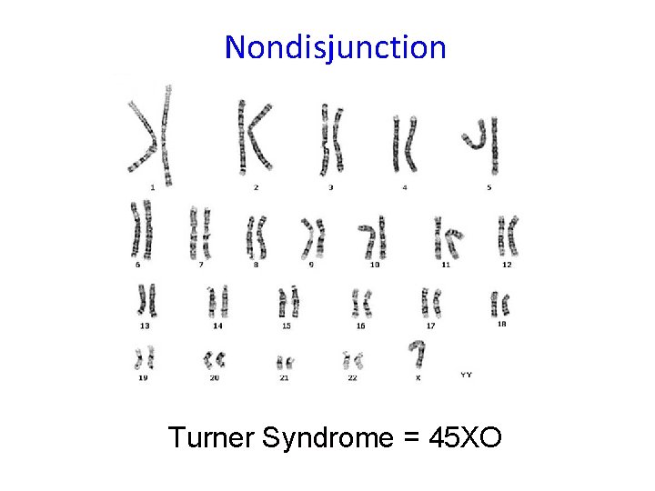 Nondisjunction Turner Syndrome = 45 XO Nondisjunction Turner Syndrome = 45 XO