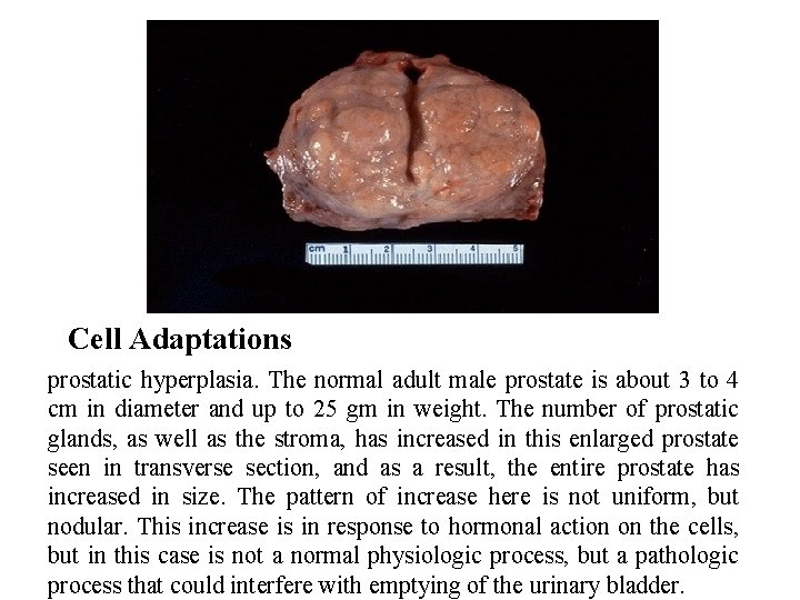 Cell Adaptations prostatic hyperplasia. The normal adult male prostate is about 3 to 4
