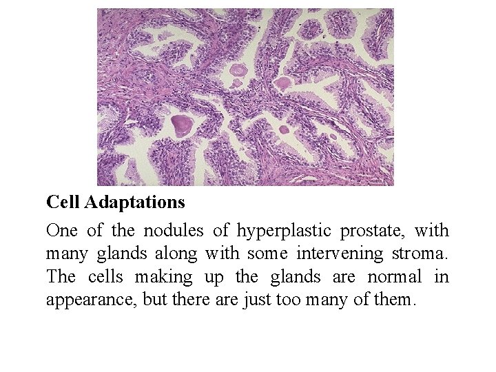 Cell Adaptations One of the nodules of hyperplastic prostate, with many glands along with