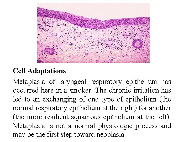 Cell Adaptations Metaplasia of laryngeal respiratory epithelium has occurred here in a smoker. The