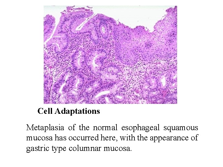 Cell Adaptations Metaplasia of the normal esophageal squamous mucosa has occurred here, with the