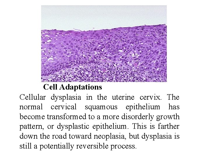Cell Adaptations Cellular dysplasia in the uterine cervix. The normal cervical squamous epithelium has