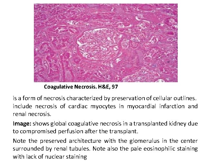 Coagulative Necrosis. H&E, 97 is a form of necrosis characterized by preservation of cellular