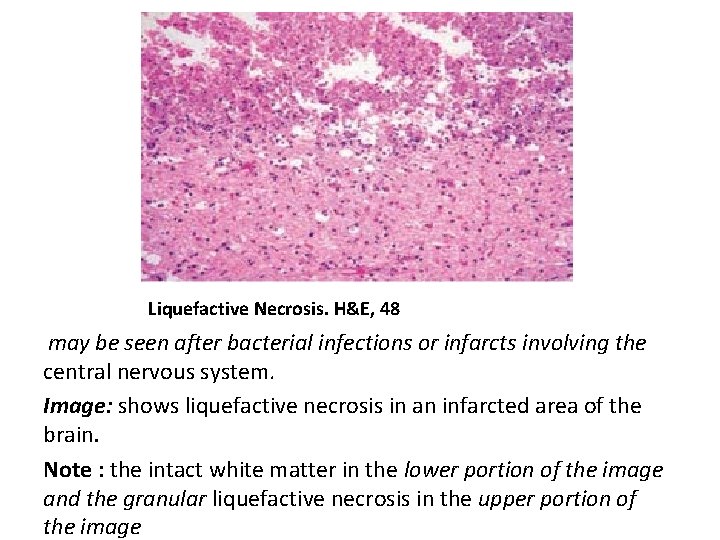 Liquefactive Necrosis. H&E, 48 may be seen after bacterial infections or infarcts involving the