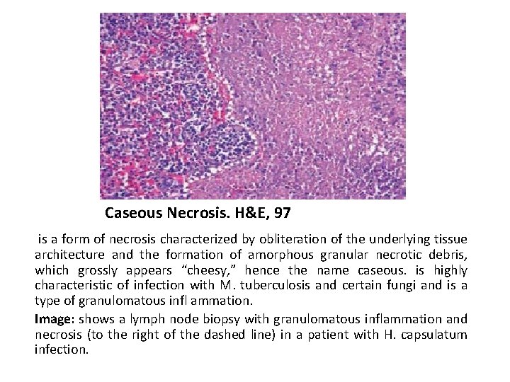 Caseous Necrosis. H&E, 97 is a form of necrosis characterized by obliteration of the