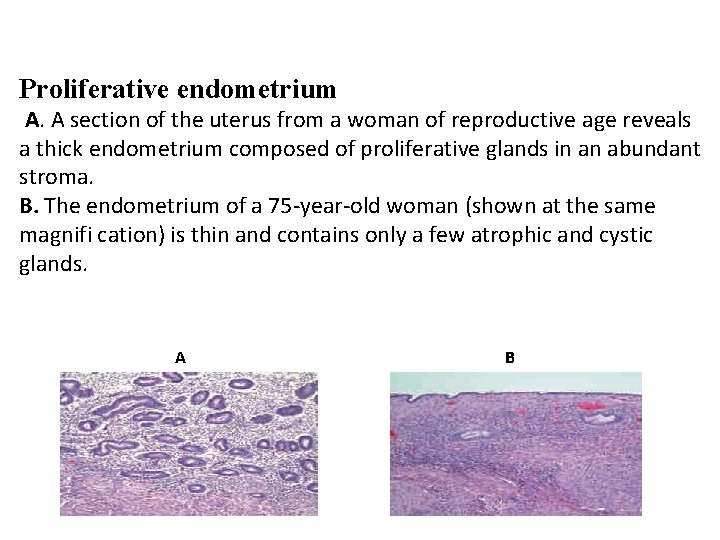 Proliferative endometrium A. A section of the uterus from a woman of reproductive age