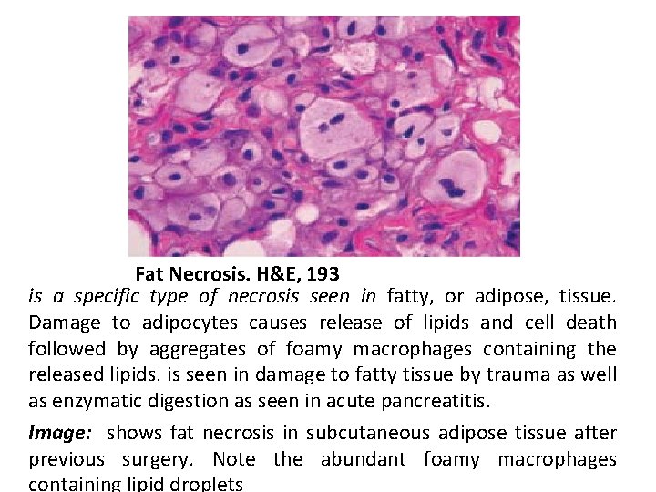 Fat Necrosis. H&E, 193 is a specific type of necrosis seen in fatty, or