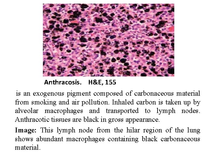 Anthracosis. H&E, 155 is an exogenous pigment composed of carbonaceous material from smoking and