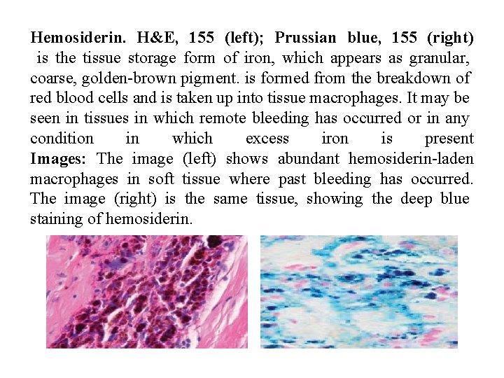 Hemosiderin. H&E, 155 (left); Prussian blue, 155 (right) is the tissue storage form of