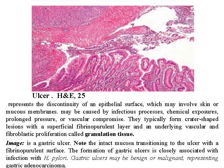Ulcer. H&E, 25 represents the discontinuity of an epithelial surface, which may involve skin