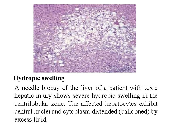 Hydropic swelling A needle biopsy of the liver of a patient with toxic hepatic