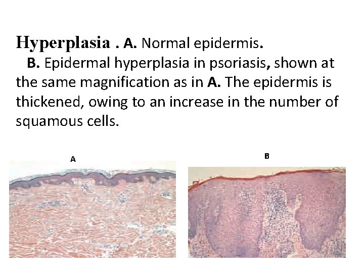 Hyperplasia. A. Normal epidermis. B. Epidermal hyperplasia in psoriasis, shown at the same magnification