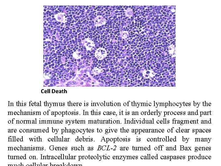 Cell Death In this fetal thymus there is involution of thymic lymphocytes by the